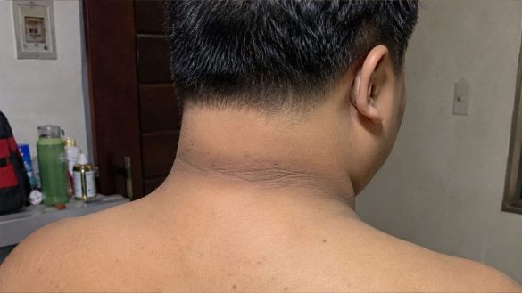 Dark Neck Causes Explained: Why It Happens and What It Could Mean