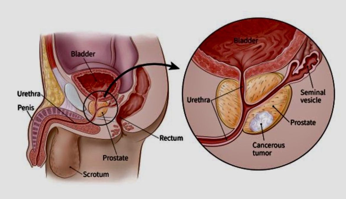 Medical illustration comparing a healthy prostate and a prostate affected by cancer for prostate cancer early detection education.