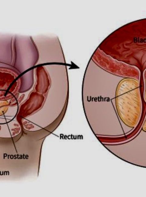 Men Shouldn’t Die from Prostate Cancer: Early Detection Can Save Lives
