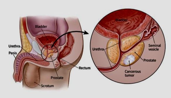 Men Shouldn’t Die from Prostate Cancer: Early Detection Can Save Lives